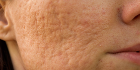 acne-littekens